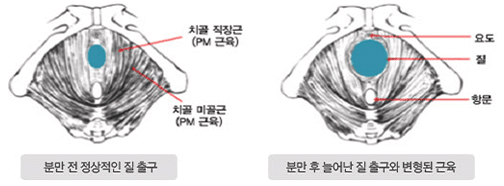 질성형 이미지