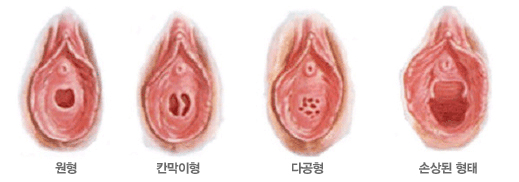 처녀막 형태 이미지