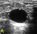 유방초음파 검사에서 발견된 물혹(A)