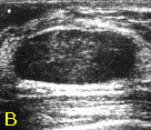 유방초음파 검사에서 발견된 섬유선종(B)