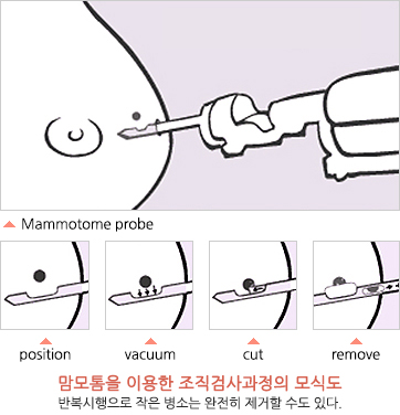 맘모톰을 이용한 조직검사과정의 모식도 - 반복시행으로 작은 병소는 완전히 제거할 수도 있다. (Mammotome probe → position → vacuum → cut → remove)