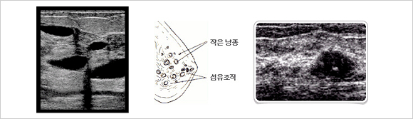 섬유 남종성 질환 초음파사진