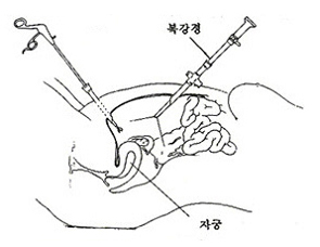 진단복강경검사 이미지