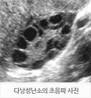 다낭성난소증후군(PCOS)