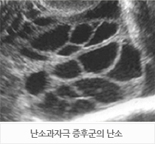 다낭성난소증후군(PCOS)