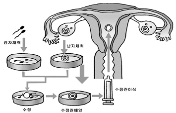 체외수정 시술방법 사진