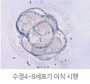 수정4~8세포기 이식 시행