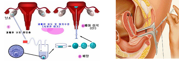 과배란 유도 및 체외수정(시험관 아기) 사진