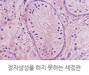 정자생성을 하지 못하는 세정관